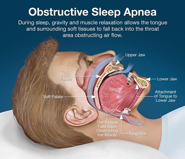 sleep apnea treatment nj