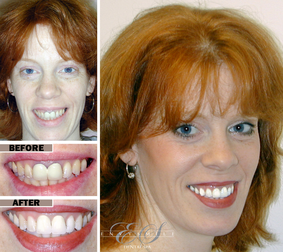 Gum Disease Treatment Brooklyn, NY | Before After