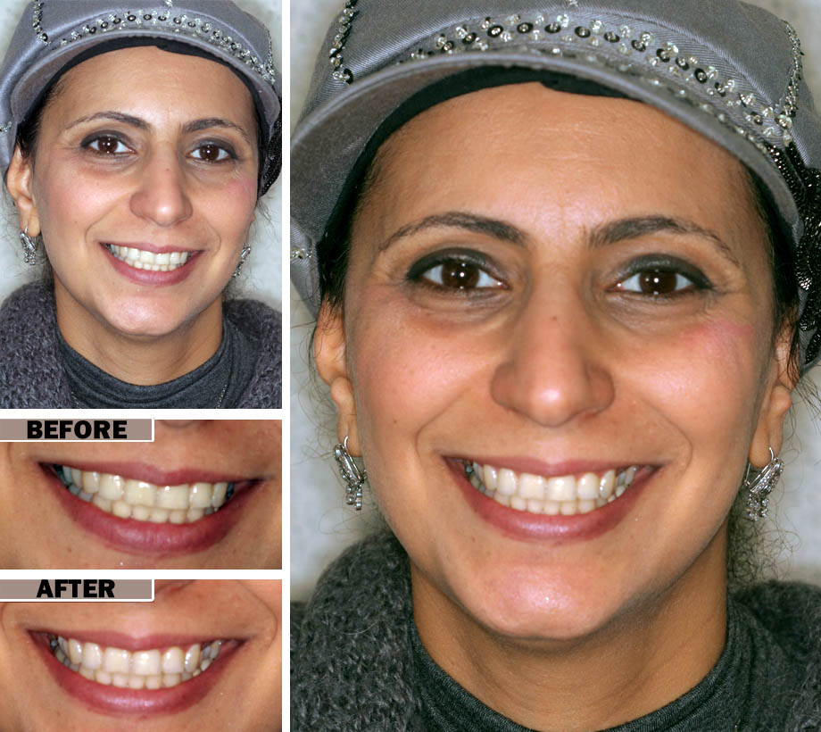 Teeth Cleaning Brooklyn | Before After