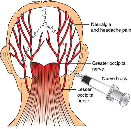 Occipital Nerve Block Doctor in NYC, Specialist · Sports Injury Clinic