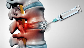 Cervical Epidural Steroid Injection in NYC | Injections for Back Pain in New York