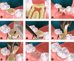 Tooth Extraction in Brooklyn, Wisdom Teeth Removal - Top Brooklyn Dentists