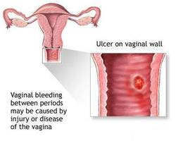 Abnormal Uterine Bleeding, Gynecology Specialist, Doctor | Gynecologist Midtown Manhattan NYC