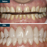 Dental Veneers Yonkers | Best Press On Teeth, Porcelain Veneers Dentists