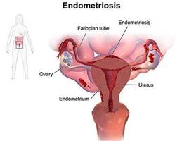 Endometriosis Treatment Specialist, Doctor in NYC | Midtown Gynecologist Manhattan NY