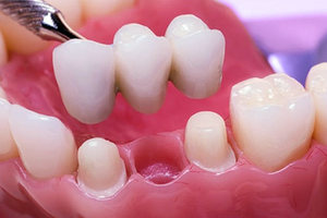 Dental Bridges – Dental Bridge Cost | Best Dentist in Brooklyn