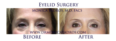 Eyelid Surgery (Blepharoplasty) Before and After Photos of NJ Patients