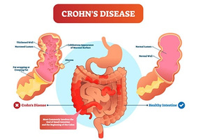 NYC Crohn’s Disease Specialist Doctor / Gastroenterologist