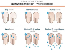 Hyperhidrosis, Excessive Sweating Treatment in NYC