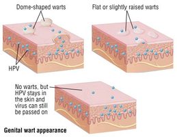 Genital Warts · Dermatologist · Cosmetic Laser Dermatology NYC