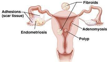 Endometrial Polyps, Uterine Polyps Specialist, Doctor | Gynecologist Midtown Manhattan NYC