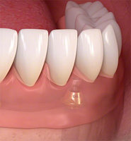 Front Tooth Implant | Midtown & Upper East Side, NYC Dentist