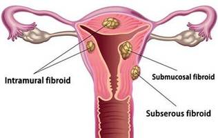 Uterine Fibroids | Enlarged Uterus Specialist, Doctor | Gynecologist Midtown Manhattan NYC