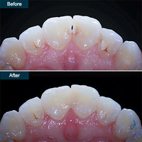 Dental Bonding in Brooklyn NY (Cosmetic Teeth Bonding) · Top Rated Cosmetic Dentist