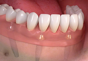 Replace Denture With a Fixed Arch of Teeth – Midtown Manhattan & Upper East Side, NYC