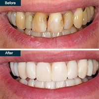 Teeth Whitening (laser teeth whitening)