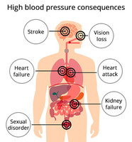 High Blood Pressure Doctor - New York Cardiac Diagnostic Center Upper East Side