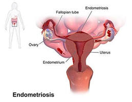 Endometriosis - OB/GYN Physicians