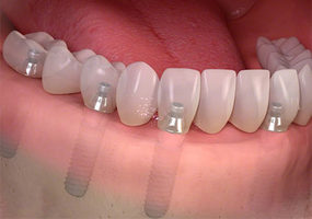 Restore the Entire Upper or Lower Arch of Teeth in One Complete Bridge – All on 6 Dental Implants