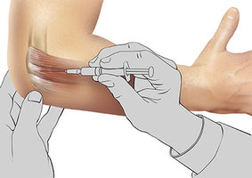 Elbow Injections (platelet-rich plasma, PRP) in NYC | Elbow Pain Doctors Specialists