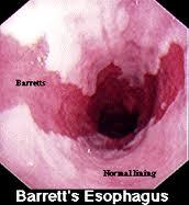 Top GI Doc NYC: Barrett’s Esophagus| NYC Gastroenterologists