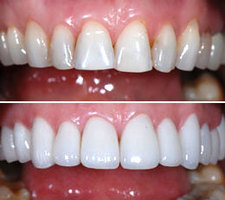 Porcelain Crowns, Top Cosmetic Dentist in Brooklyn – Dr. Dekhtyar