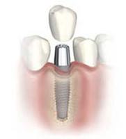 New Teeth in 1 Hour | Dental Implants | NYC Dentist