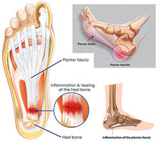 NYC Foot Injections (cortisone, steroid) · Sports Injury Clinic