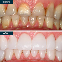 Dental Crown, Teeth Crowns (ceramic, zirconia) – Top Cosmetic Dentist Yonkers NY