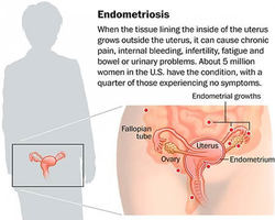 Endometriosis Signs and Symptoms - OB/GYN Physicians
