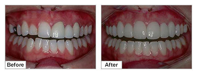 Dental Veneers, Veneer Teeth Cost · Best Rated Dentist in Brooklyn Dr. Dekhtyar