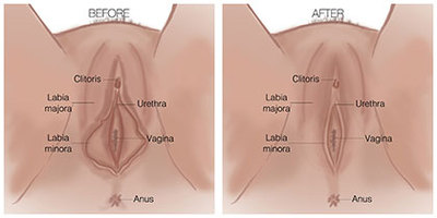Labiaplasty Vaginal Surgery - OB/GYN Physicians