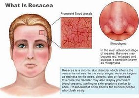 Rosacea · Manhattan Dermatologist · Cosmetic, Laser Dermatology in NYC