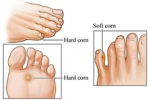 Corn Removal Surgery NYC · New York Corn Removal Podiatrist, Specialist in Midtown Manhattan