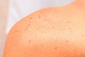 Age Spots Removal · Manhattan Dermatologist · Cosmetic Laser Dermatology NYC