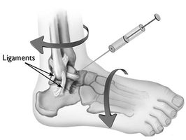 NYC Ankle Injection Doctor, Ankle Pain Specialist · Sports Injury Clinic