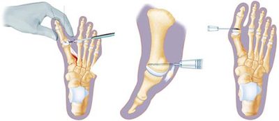 Minimally Invasive Foot Surgery · Foot Doctor, Specialist · Podiatrist Midtown Manhattan NYC