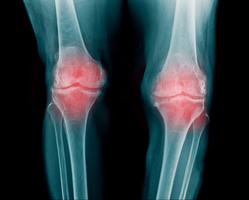 7 Surprising Symptoms of Osteoarthritis That You Need to Know