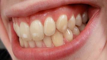 9 Most Common Causes of Tooth Stains