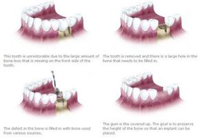 Bone loss in teeth. Preparation for Dental Implants