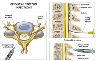 NYC Lumbar Epidural Steroid Injection, Cortisone Shot · Top Rated Back Pain Specialist