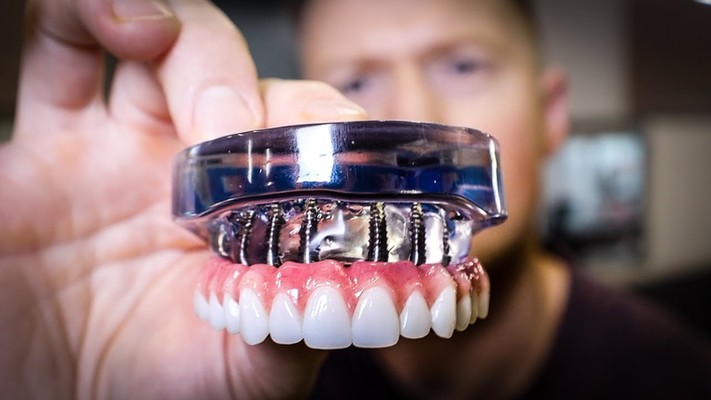 Everything You Should Know About Full Mouth Dental Implants