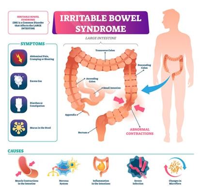 Irritable Bowel Syndrome (IBS) Treatment Specialist NYC Gastroenterologist / IBS GI Doctors NYC