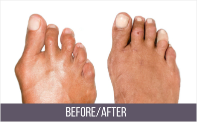 Bunion Surgery Specialists